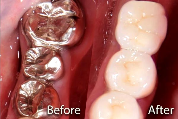 Ceramic crowns versus metal crowns. Before and after comparison photos.