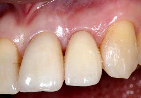 Dental implant front tooth after