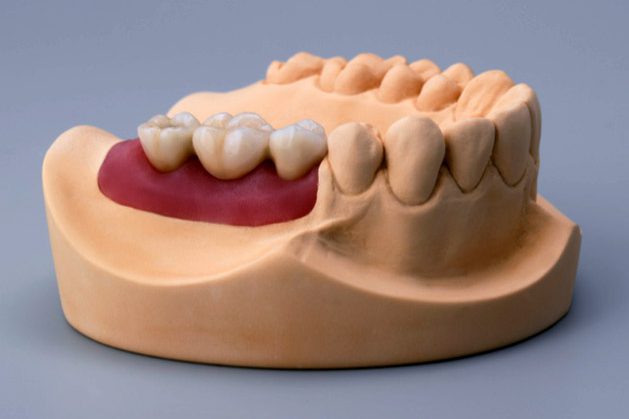 Dental implant model gum and bone