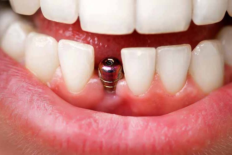 Dental implant post without crown