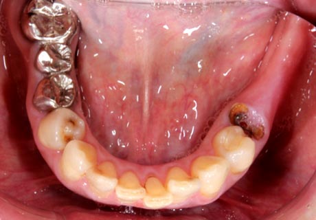 Dental implant rear teeth before