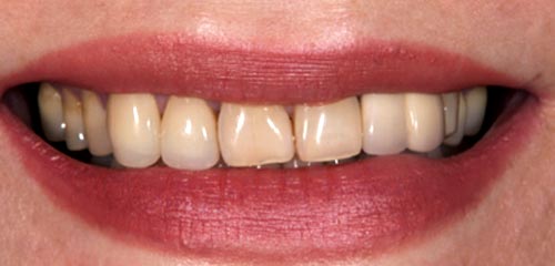 Esthetics and Orthodontics Example 1 Before