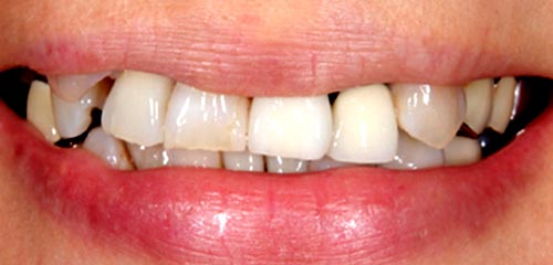 Esthetics and Orthodontics Example 2 Before