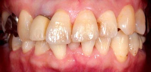 Esthetics and Orthodontics Example 3 Before
